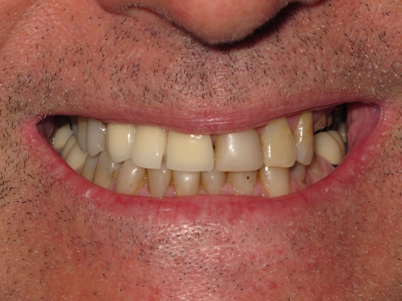 Veneers In Neutral Bay Sydney Cosmic Smile Laser Dental