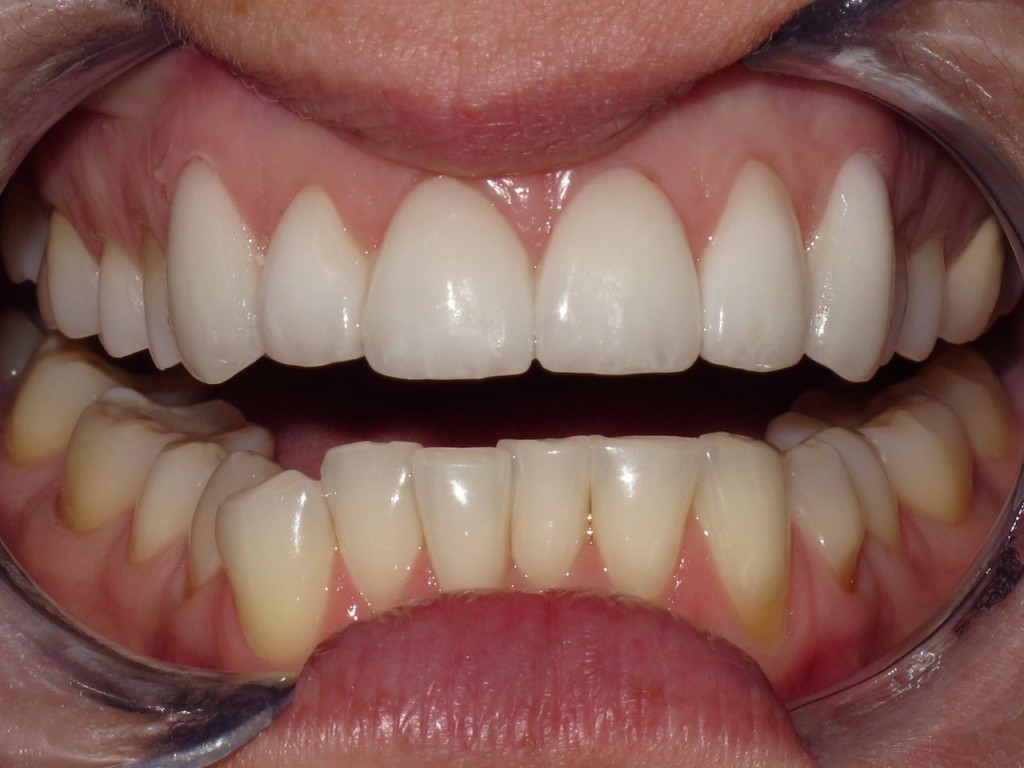 Crowns And Veneers Before And After Cosmic Smile Dental