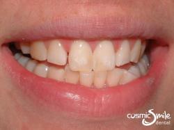 Enamel microabasion – After – Staining removed