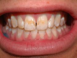 Enamel microabasion – Before – Front teeth stained