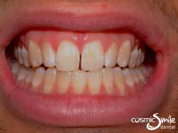 Enamel microabasion – Before – Stains removed