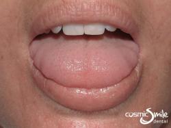 Laser Frenectomy – Before treatment
