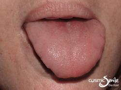 Laser Frenectomy – After laser tongue-tie surgery