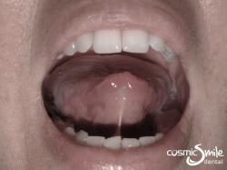 Laser Frenectomy – Tongue lifted showing frenulum
