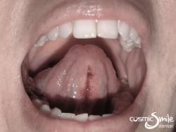 Laser Frenectomy – After laser frenectomy