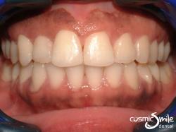 Invisalign – Crossbite corrected with Invisalign