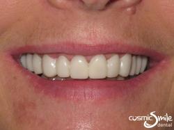 Snap on Smile – Snap-on Smile in place