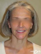 Snap on Smile – Snap-on Smile in place – Full face