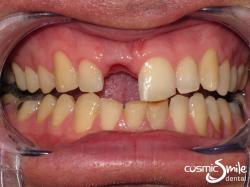 Dental Implant – Before – Missing front right central incisor