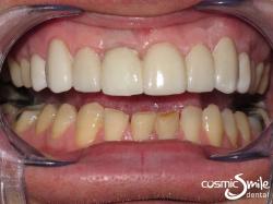 Dental Implant – After – Restored central incisor and lumineers on front teeth