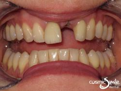 Dental Implant – Before – Front left central missing