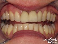 Dental Implant – After – Front left central restored