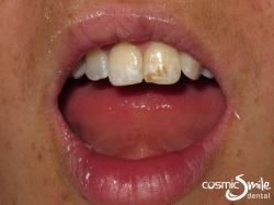 Enamel microabasion – Before – Centrals with dark brown enamel staining