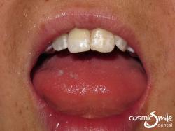 Enamel microabasion – After – Centrals with dark brown enamel staining removed