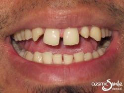 Composite – Large gaps because of a missing tooth and a peg lateral