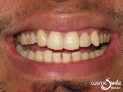 Composite – Gaps closed with white composite resin in about an hour