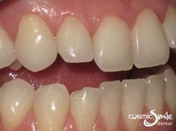 Composite – Closeup showing the short upper right lateral incisor and the chip on the lower right lateral incisor