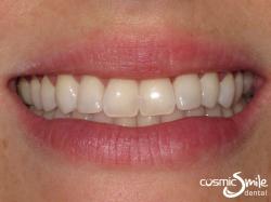 Composite – Beautiful smile with the lateral incisors lengthened