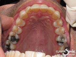 Invisalign – Front teeth straightened – top view