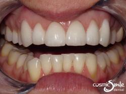 Porcelain veneers – After – Beautiful, white smile