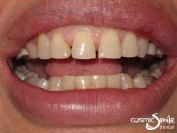 Porcelain veneers – Before – Yellowish with spaces between front teeth