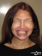 Porcelain veneers – Before – Full face – Yellowish with spaces between front teeth