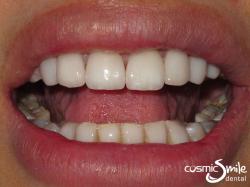 Porcelain veneers – After – White teeth with all spaces closed