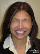 Porcelain veneers – After – Full face – White teeth with all spaces closed