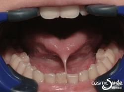 Laser Frenectomy – Tongue tie to the tip of the tongue