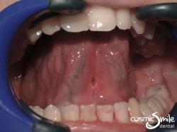 Laser Frenectomy – Tongue tie after laser surgery