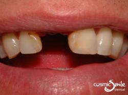 Dental Implant – Right central incisor missing