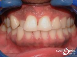 Invisalign – Upper right lateral incisor in crossbite