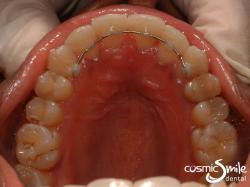 Invisalign – Alignment corrected and wire retainer in place