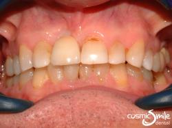 Dental Implant – Implant restored right central incisor