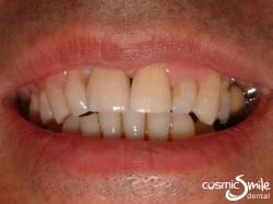 Dental Implant – Implant restored with right central incisor
