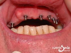 Dental Implant – Mini implants in upper jaw