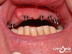 Dentures 5 – Mini implants in upper jaw