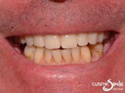Dental Implant – Upper denture retained by mini implants