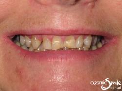 Snap on Smile – Dark, worn, uneven front teeth