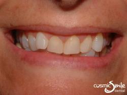 Lumineers – Misaligned front teeth