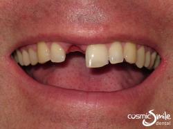 Lumineers – Missing tooth, worn, yellow teeth
