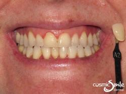 ZOOM teeth whitening – Before – Shade A2