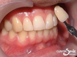 ZOOM teeth whitening – Before – Shade A2