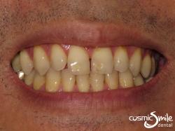 Lumineers – Yellowish teeth with diastemas