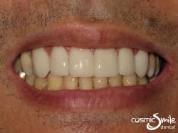 Lumineers – Whiter teeth without diastemas