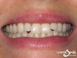 Composite – Clear spaces between the upper and lower lateral incisors