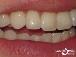Composite – Composite resin modifications made to create a very natural smile