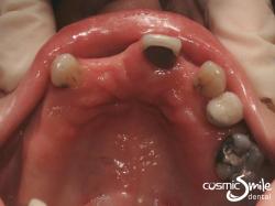 Dental Implant – Before – Top view of remaining natural teeth