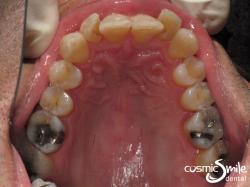 Invisalign – Front teeth retroclined – top view