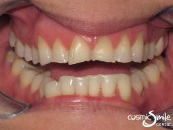 Porcelain veneers – Before – Worn, crooked front teeth